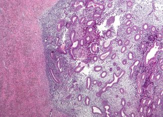 Micrografía de endometriosis ovárica. Nephron, 2010. Recuperada de Wikimedia Commons. CC BY-SA 3.0